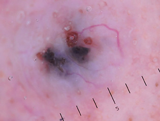 基底細胞癌 Basal Cell Carcinoma 圖1