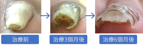 60歲卷甲(pincer nail)男性接受指甲矯正