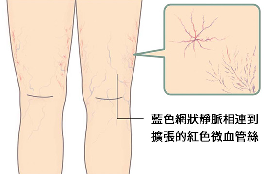 網狀靜脈擴張-示意圖1-藍色網狀靜脈相連到擴張的紅色微血管絲