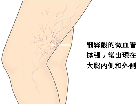 微血管擴張-示意圖-細絲般的微血管擴張,常出現在大腿內側和外側